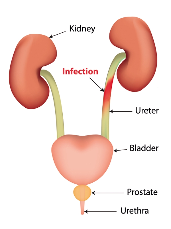 Urinary Tract Infection Complicated Signs And Symptoms MIMS Vietnam